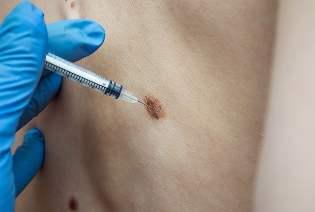 Core Needle Biopsy