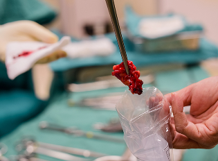 Surgical (Open) Biopsy
