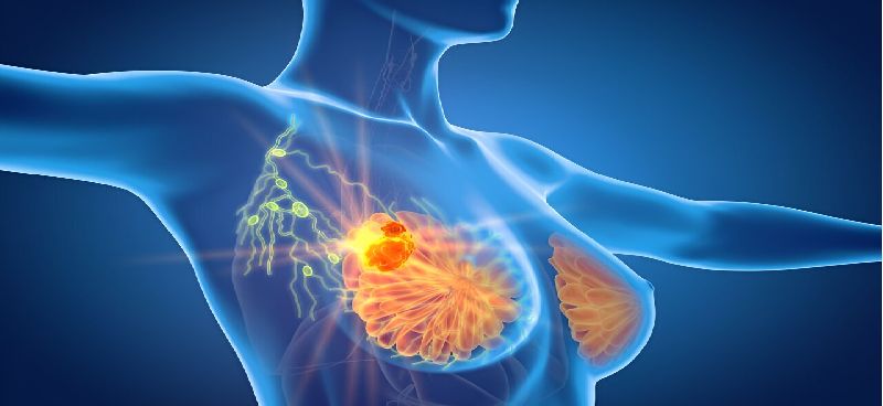 Early Warning Signs of Breast Cancers: Recognizing Symptoms and Seeking Timely Diagnosis