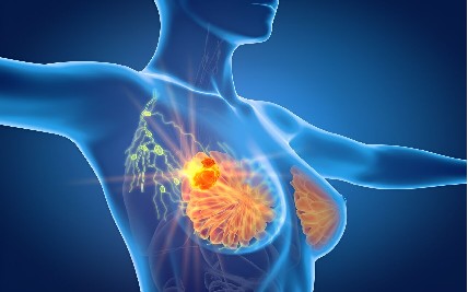 Early Warning Signs of Breast Cancers: Recognizing Symptoms and Seeking Timely Diagnosis