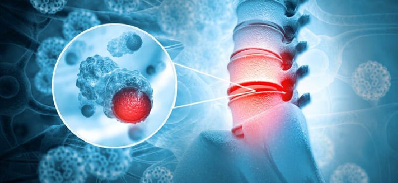 Early Warning Signs of Sarcoma and Bone Cancers: Recognizing Symptoms and Seeking Timely Diagnosis
