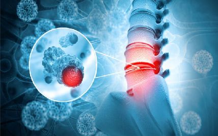 Early Warning Signs of Sarcoma and Bone Cancers: Recognizing Symptoms and Seeking Timely Diagnosis