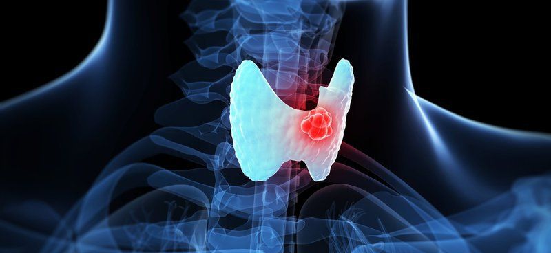 Understanding Thyroid Cancer: A Comprehensive Guide