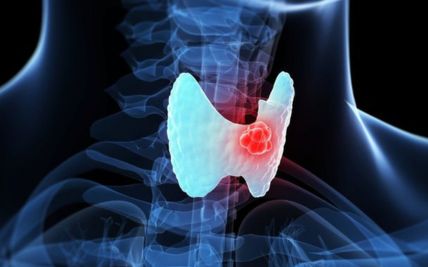 Understanding Thyroid Cancer: A Comprehensive Guide