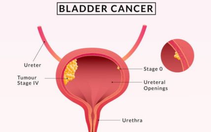 Bladder Cancer in Women vs. Men: Unveiling Distinctive Patterns and Perspectives