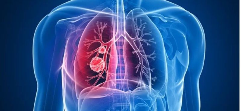 7 Healthy Habits That Help You During Lung Cancer Treatment