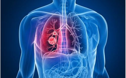 7 Healthy Habits That Help You During Lung Cancer Treatment