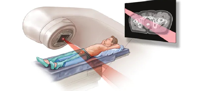 Radiation Therapy for Prostate Cancer: Understanding Options, Side Effects, and Advances in Treatment