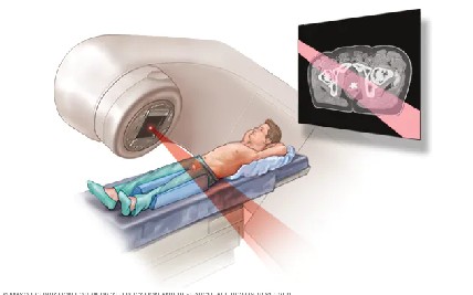 Radiation Therapy for Prostate Cancer: Understanding Options, Side Effects, and Advances in Treatment