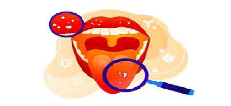 Oral Cancer Screening: What You Need to Know