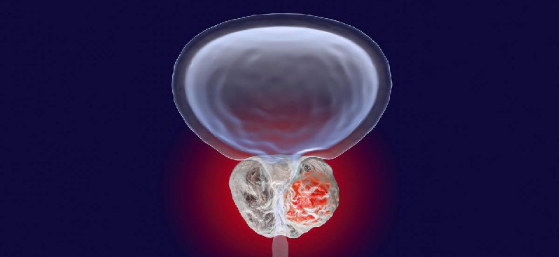 Navigating Medical Oncology Treatments for Prostate Cancer: A Comprehensive Guide