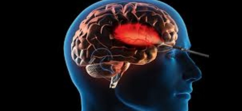 The Rise of Keyhole Brain Surgery: How It’s Changing Neurosurgery