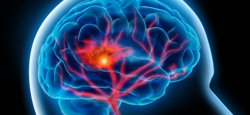 Understanding the Warning Signs of Stroke: Act FAST to Save a Life and choose the right hospital