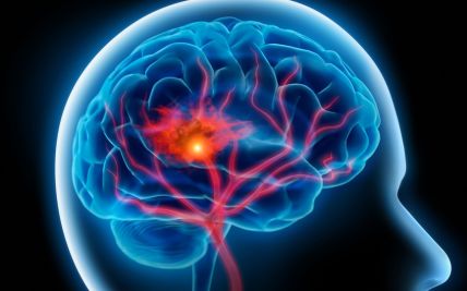 Understanding the Warning Signs of Stroke: Act FAST to Save a Life and choose the right hospital