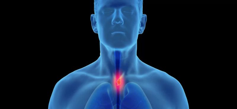 Understanding Esophageal Cancer – A Comprehensive Guide