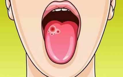 9 Proven Ways to Prevent Oral Cancer
