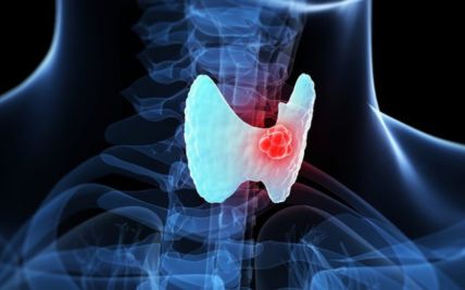 Is Thyroid Cancer in Women More Common?