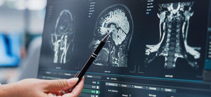 Role of Neurosurgery in the Treatment of Traumatic Brain Injuries