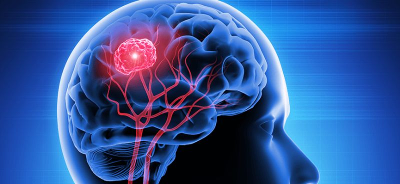 How Surgery Helps People with Brain Tumors and Epilepsy