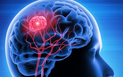 How Surgery Helps People with Brain Tumors and Epilepsy