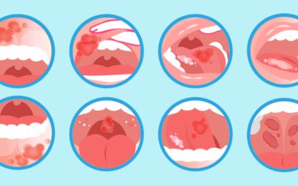 Oral Cancer