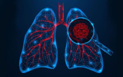 Lung Cancer