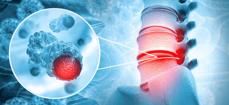 Pediatric Sarcoma and Bone Cancer: Unique Challenges and Treatment Approaches