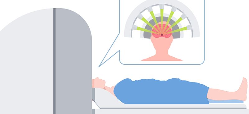 Understanding Radiosurgery or Stereotactic Radiosurgery for Precise Brain and Spine Treatment