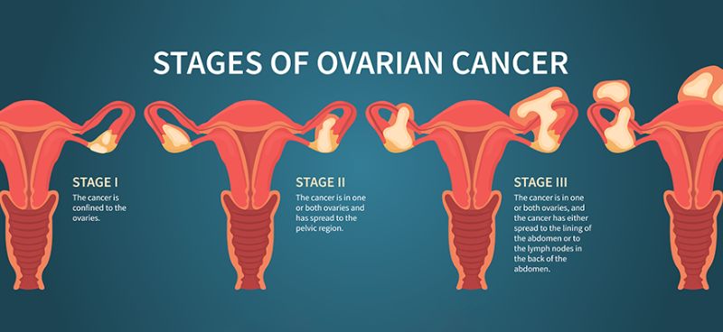 Ovarian Cancer – Everything you need to know about it