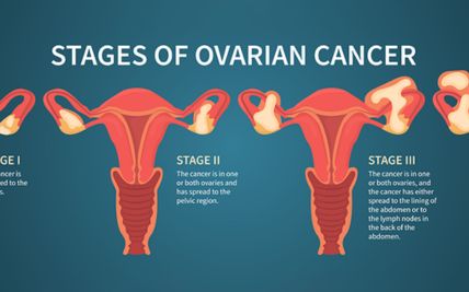 Ovarian Cancer – Everything you need to know about it