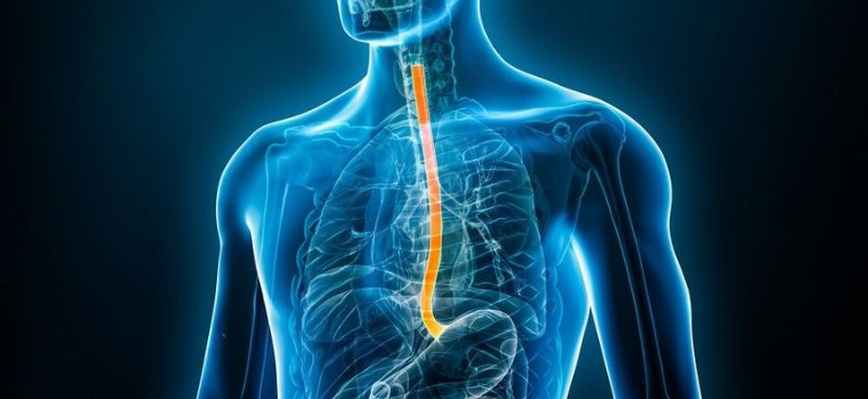 Esophageal Cancer
