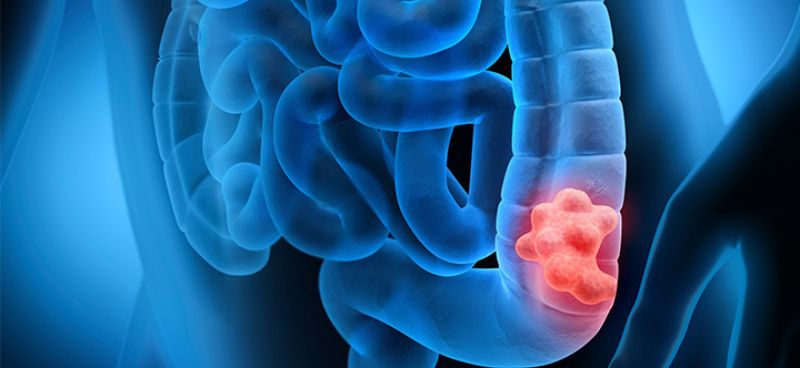 Colorectal Cancer