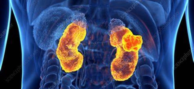 Everything You Need to Know About Kidney Cancer