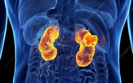 Everything You Need to Know About Kidney Cancer