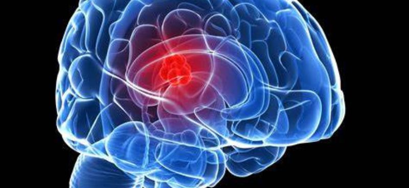 CyberKnife Radiotherapy for Brain Tumors