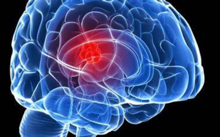 CyberKnife Radiotherapy for Brain Tumors