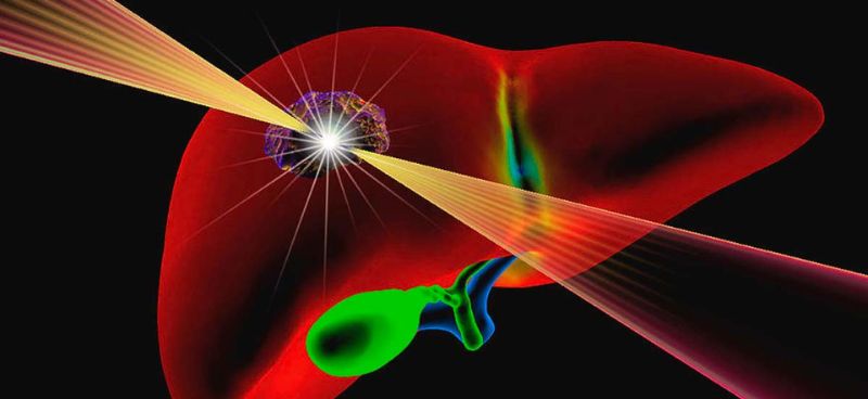 Radiation Therapy in Liver Cance