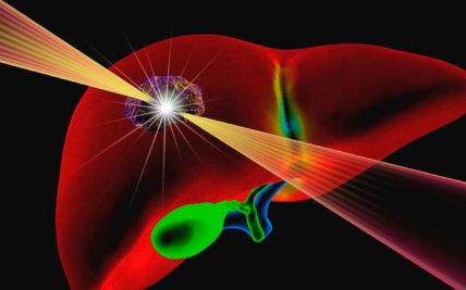 Radiation Therapy in Liver Cance