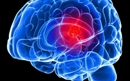 Early Warning Signs of Glioblastoma: Recognizing Symptoms and Seeking Timely Diagnosis