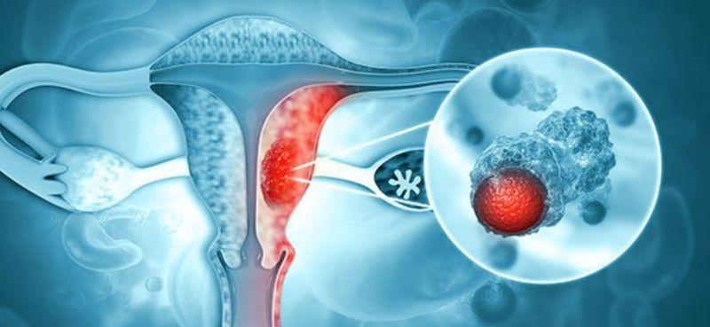 Navigating Gynaecological Cancer During Pregnancy: Challenges and Care Options
