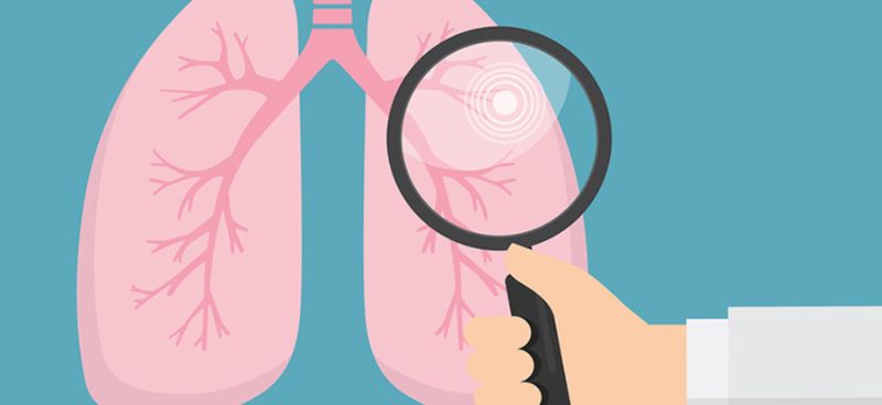 Lung Cancer Screening  What You Need to Know