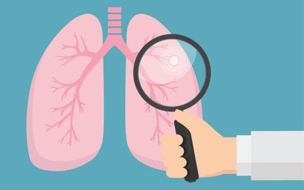 Lung Cancer Screening  What You Need to Know