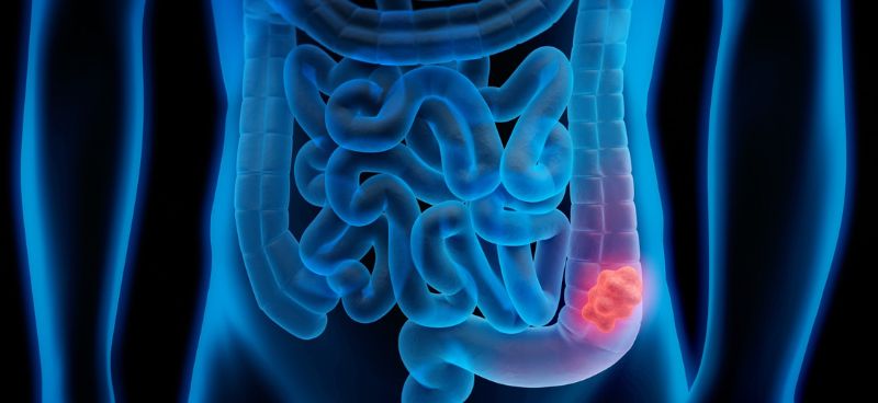 Early Warning Signs of Colon Cancer: Recognizing Symptoms and Seeking Timely Diagnosis