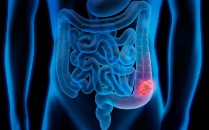 Early Warning Signs of Colon Cancer: Recognizing Symptoms and Seeking Timely Diagnosis
