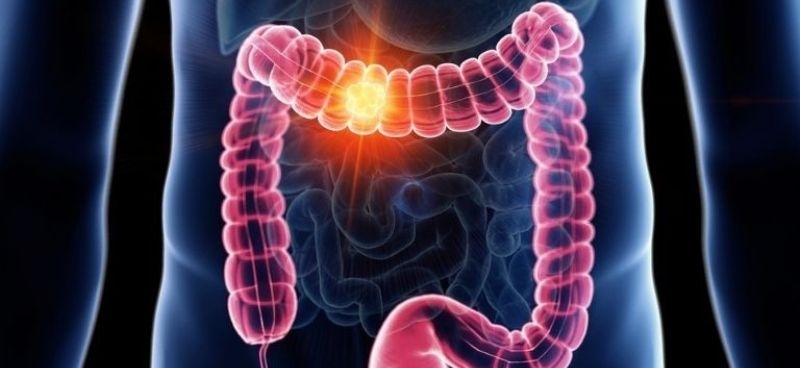 Colorectal Cancer