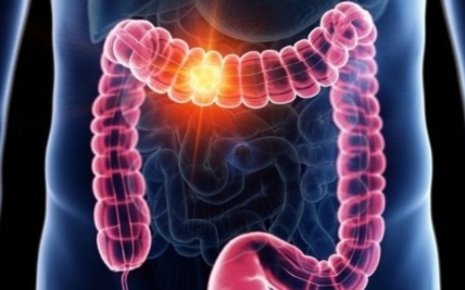 Colorectal Cancer