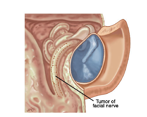 tumor of facial nerve