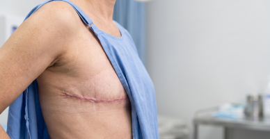 Mastectomy