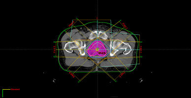 3D Conformal Radiation Therapy