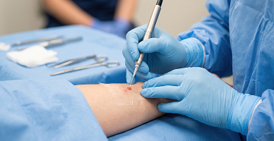 Curettage and Electrodessication